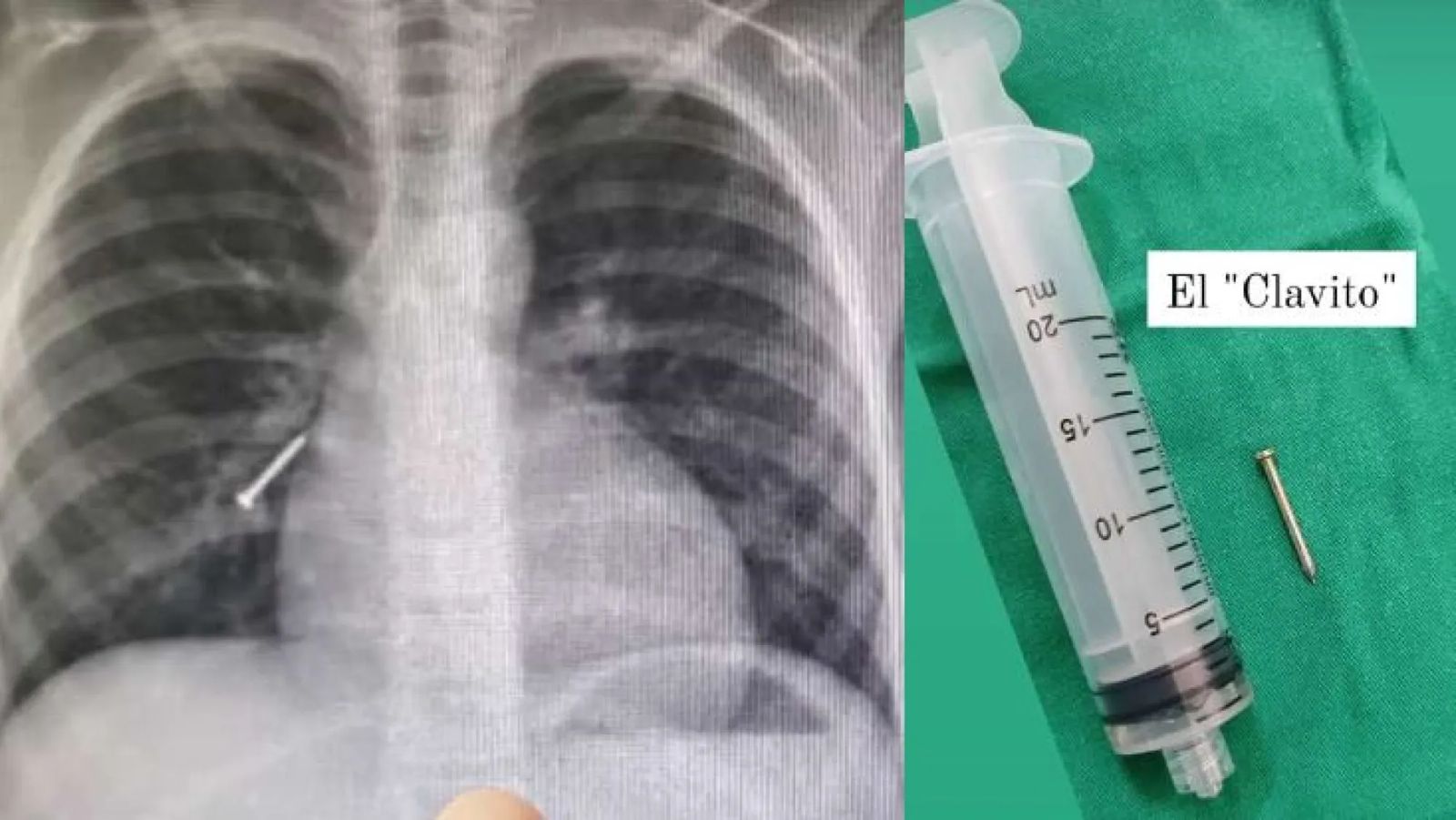 Sacaron un clavito del pulmón de un niño