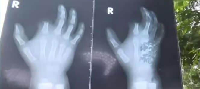 Ypané: Perro destroza la mano de un menor en un ataque