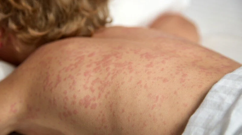 Paraguay lleva once semanas sin nuevos casos de sarampión