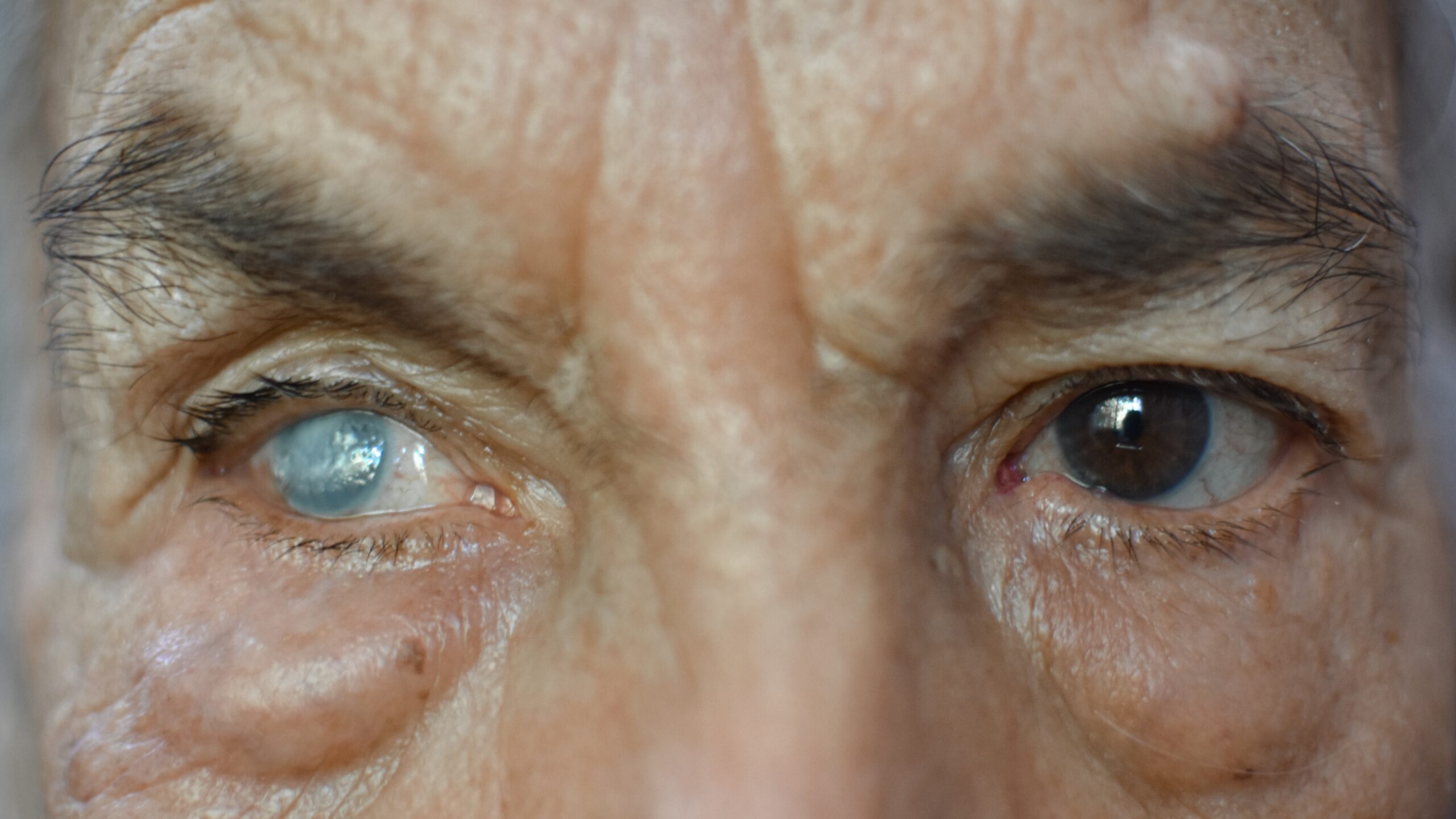 Cataratas: El enemigo silencioso que apaga la visión