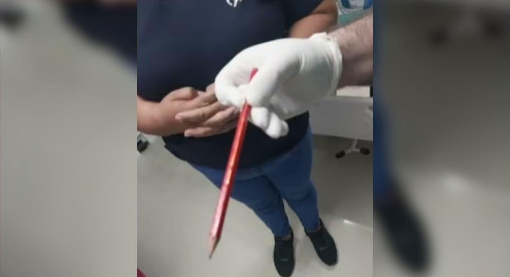 Niño termina con perforación intestinal por «broma» con un lápiz